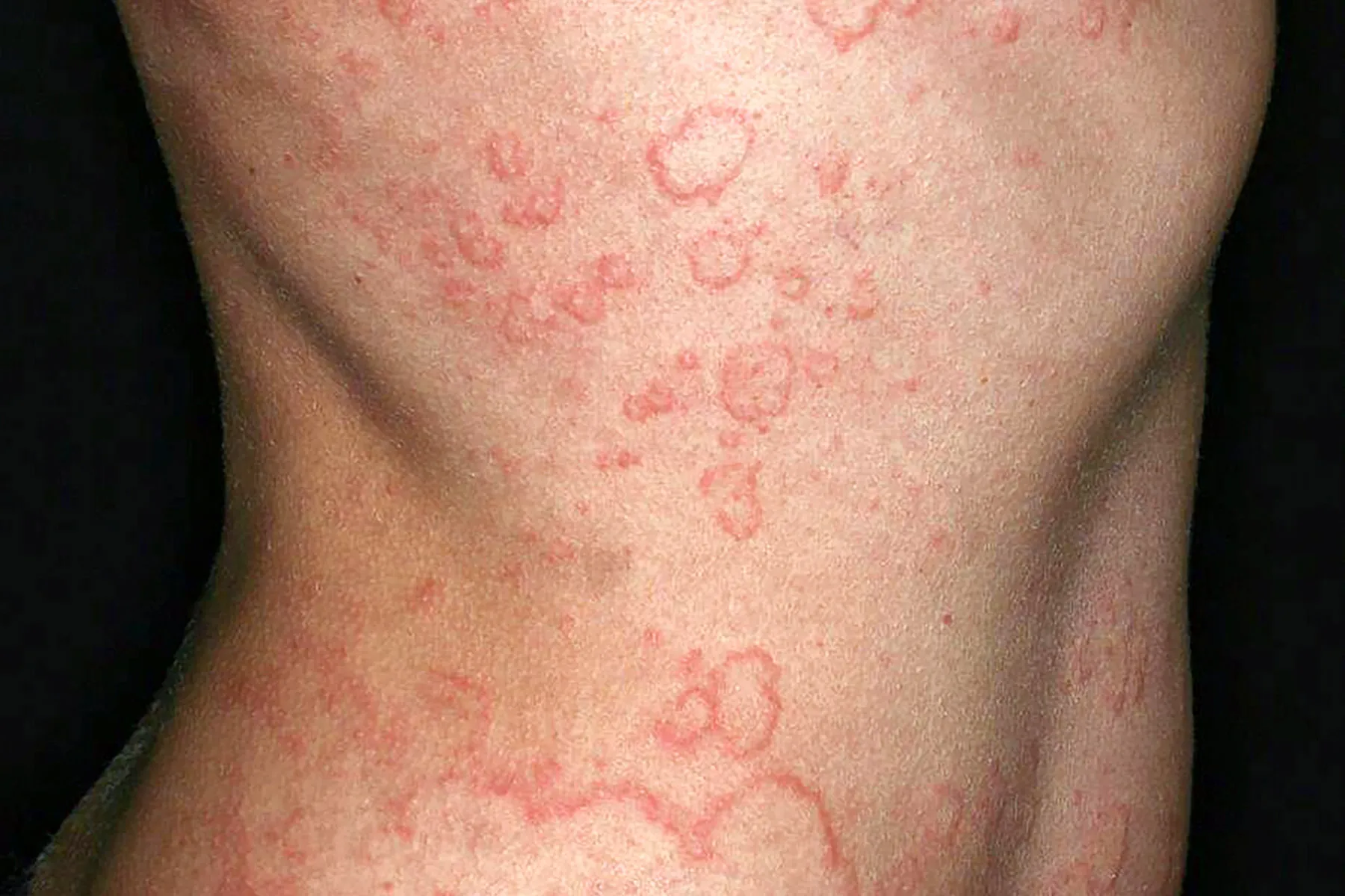 Chronic Spontaneous Urticaria What To Know