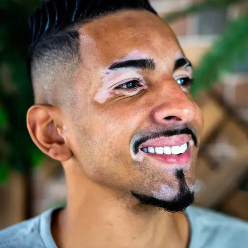 photo of man with vitiligo on face