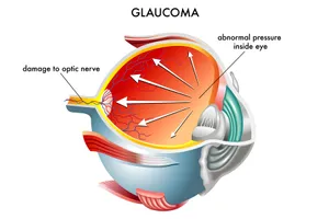 What glaucoma looks like within the eye.