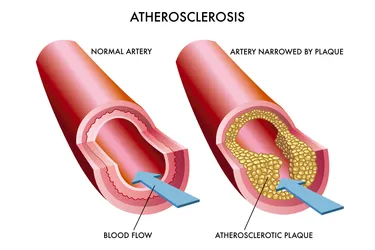 High blood pressure raises the risk of atherosclerosis.