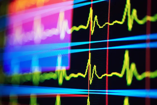 Both AFib and SVT are diagnosed with an electrocardiogram (EKG).