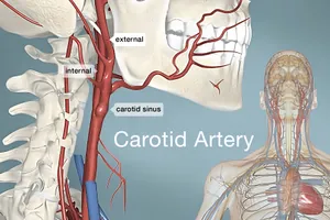 Carotid Artery Disease: Symptoms, Causes, Diagnosis, Treatment