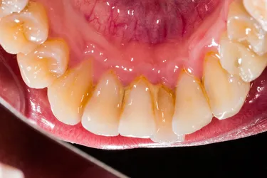 Plaque buildup can lead to gum disease and gingivitis. (Photo Credit: Kingfisher Productions / Getty Images)