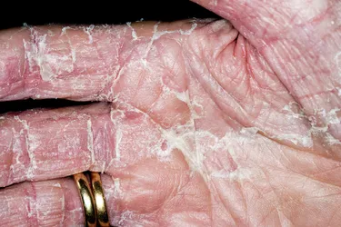 Exfoliative dermatitis can cause most of the skin on your body to peel, raising your risk of infections. (Photo credit: Science Source)