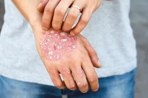 1800x1200_how_to_manage_psoriasis_on_your_hands_slideshow
