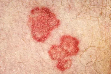 If untreated, jock itch (tinea cruris) can last for months. But antifungals available without a prescription can help clear it up in a few weeks.