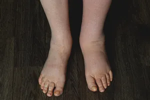 Lymphedema is swelling that’s caused by a collection of too much lymph fluid. It usually happens in your arms and legs, but it can happen in other parts of your body, as well. This swelling may cause pain and limit how well the affected area moves.