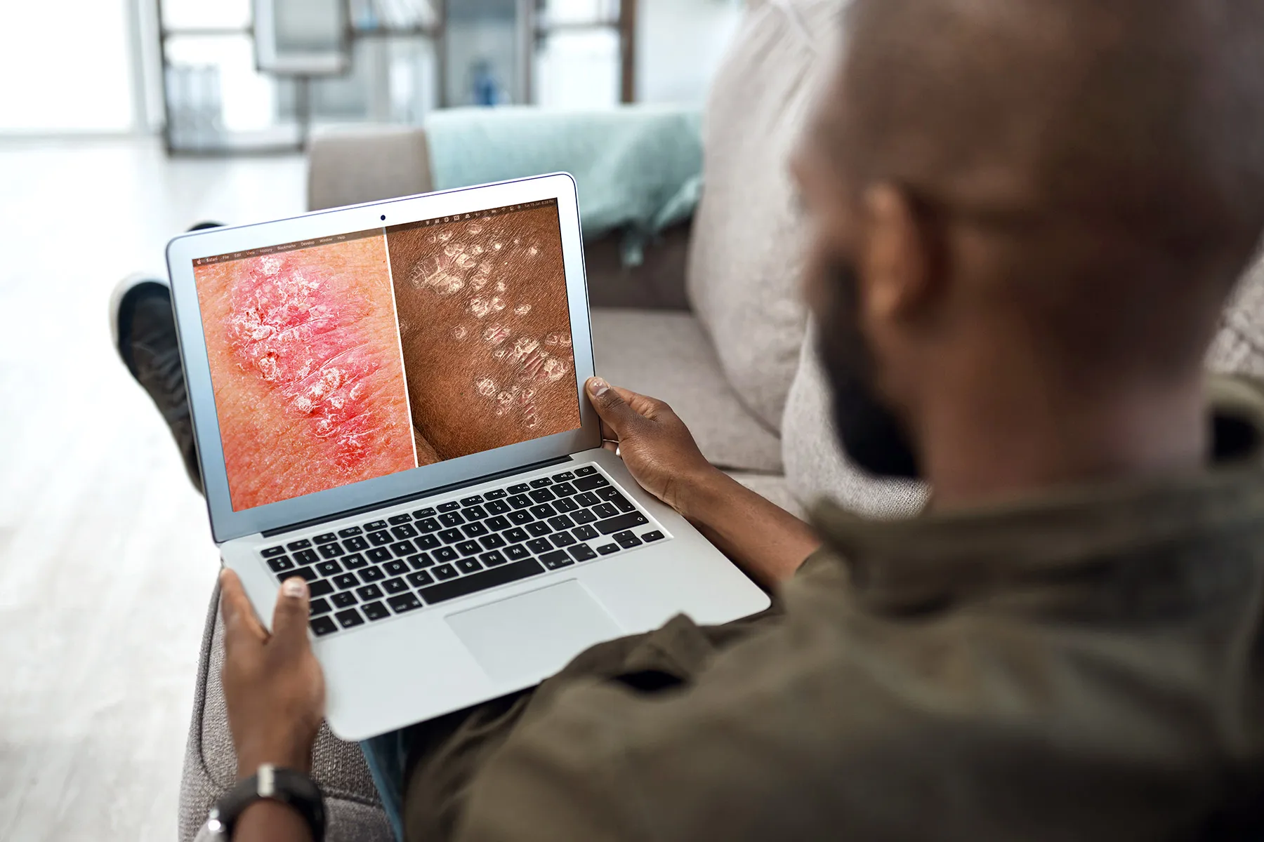 Psoriasis: Pictures, Symptoms, Causes, Diagnosis, Treatment