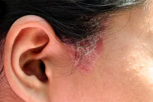 Ringworm will often look red on light skin, but brown or gray on skin of color. Most ringworm of the skin can be treated at home with creams you can buy without a prescription. Photo credit: iStock/Getty Images 