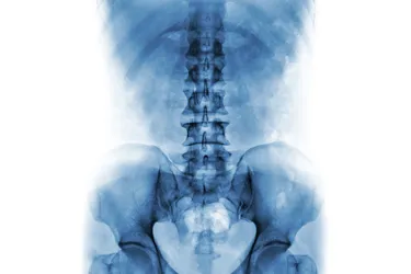 A spinal x-ray can help your doctor pinpoint serious problems. (Photo credit: Puwadol Jaturawutthichai/Dreamstime)