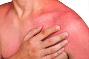Most sunburns cause mild pain and redness but affect only the outer layer of skin (first-degree burn). Photo credit: iStock/Getty  Images 