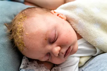 Cradle cap might occur on your baby's scalp, but it can also happen behind their ears, in their armpits, and on the back of their neck. (Photo Credit: E+ / Getty Images)