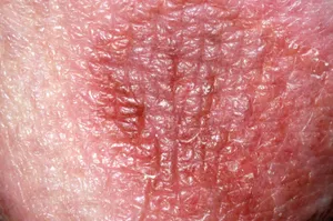 An allergic reaction to a drug can sometimes cause a rash on your genitals. 