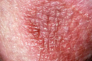 An allergic reaction to a drug can sometimes cause a rash on your genitals. 