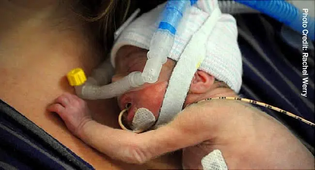 micropremie baby