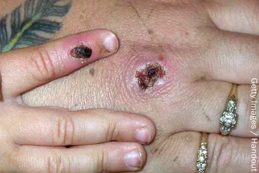 One symptom of monkeypox is a rash that turns into bumps, which then scab over.