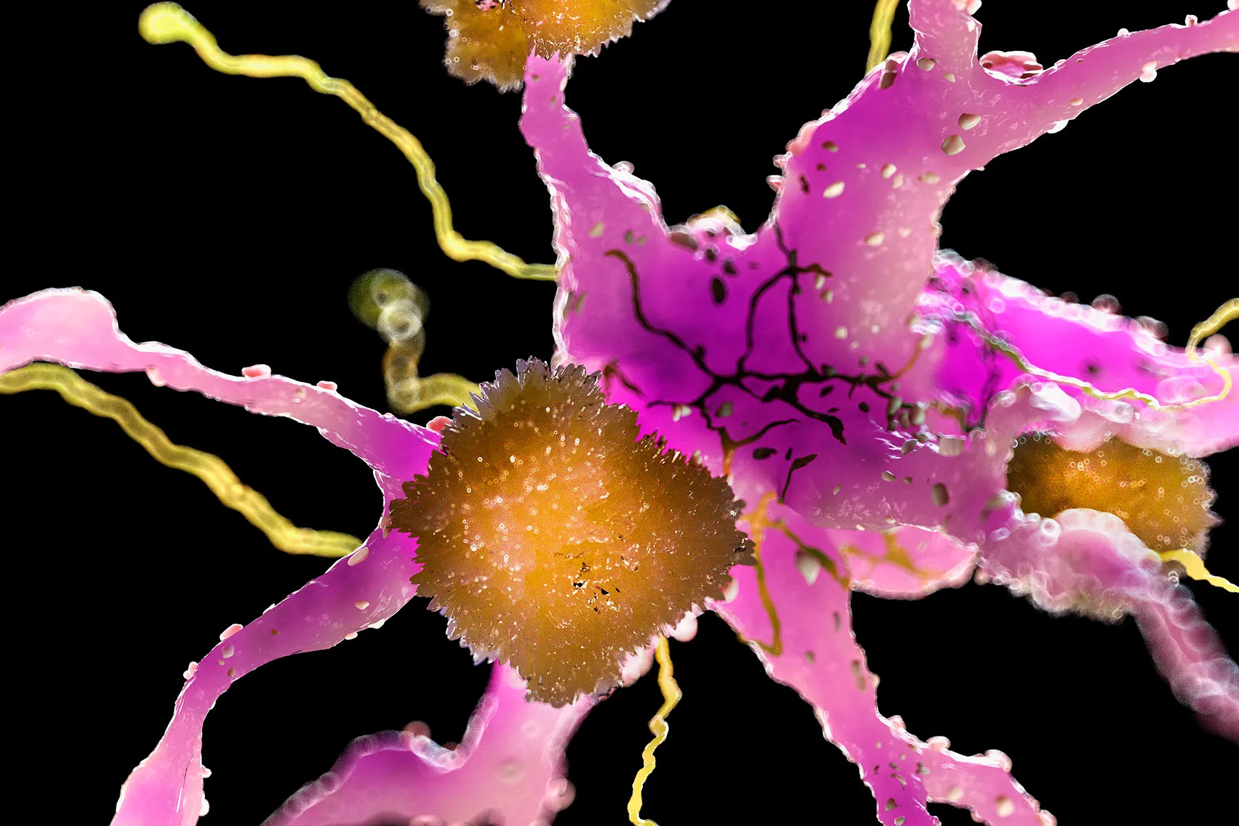 FDA Approves New Drug to Slow Alzheimer’s Disease