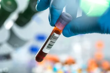 These tests measure the amount of ferritin in your blood. Ferritin is a protein that stores iron. A ferritin test can also give your doctor hints about other conditions you may have. (Photo Credit: Science Photo Library/Getty Images)
