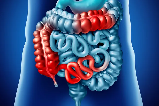 Crohn's Doesn't Define Who I Am
