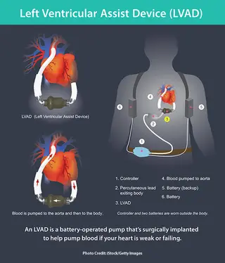 LVAD infographic