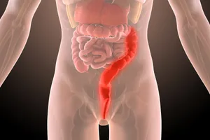 Ulcerative colitis causes inflammation in the inner lining of your colon.