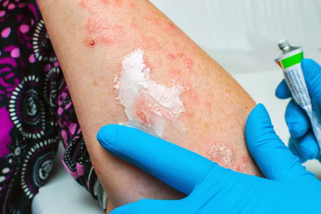 Myths and Facts About Treating Your Psoriasis