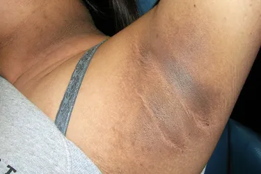 Acanthosis nigricans. Also called Velvety plaques, this is a thickening of the outer layer of skin resulting in a discoloration of brown-to-black. They can develop in the folds of the armpit, groin and/or neck and can start showing up during childhood or adulthood. Seeing this condition suggests diabetes or simply obesity. In rare cases acanthosis nigricans occurring in other places, such the hands or lips, may indicate an internal malignancy.