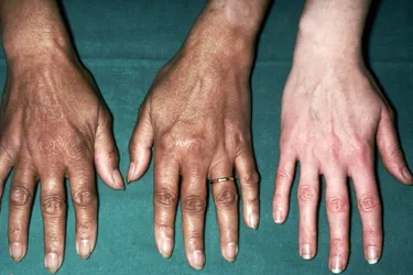 Addison’s disease. Patients with Addison’s disease experience an increase in pigmentation of the skin which turns their skin brown or almost black as shown in the hands on the left of this image. The disease itself is a rare endocrine disorder in which the adrenal gland produces insufficient amounts of steroid hormones. Addison’s can be successfully treated with medications.