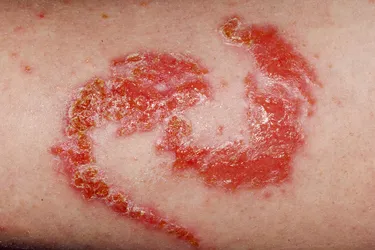 This allergic contact dermatitis is a reaction to a henna tattoo on the arm. Photo Credit (inset, arm): Science Photo Library / Science Source