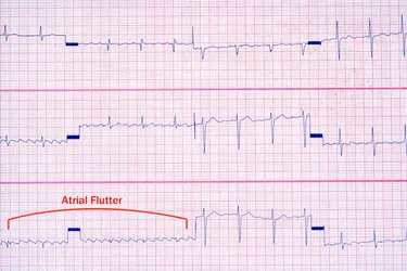 Atrial flutter is an abnormal heart rhythm that makes your heart beat too quickly. While some people don't notice symptoms, it's important to treat it to prevent further heart complications.   (Photo Credit: Southern Illinois University/Science Source)
