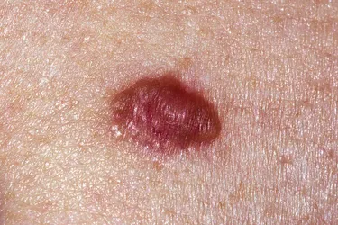 Basal cell carcinoma is the most common form of skin cancer accounting for 90% of skin cancers in the U.S. It is caused by sun damage. BCC causes small bumps and sometimes open sores on the skin. It is slow growing, and if not removed can spread into underlying tissues.