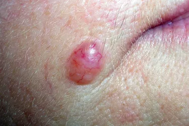 Junctional nevi. A junctional nevus involves both the outer (epiderrmis)and inner (dermis layers of skin. They are usually brown to dark brown in color and round with a uniform shape.