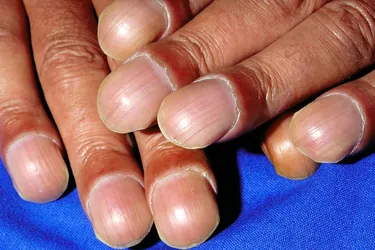 Clubbed nails occur when your fingertips bulge and the nails curve down and get shiny. The condition is usually one you are born with, but you may have other health issues as well such as heart disease or lung disease. It’s unclear what causes clubbed nails, but it happens when there are certain substances in your blood such as vascular endothelial growth factor (VEGF). Your body produces more VEGF when it can’t get enough oxygen.