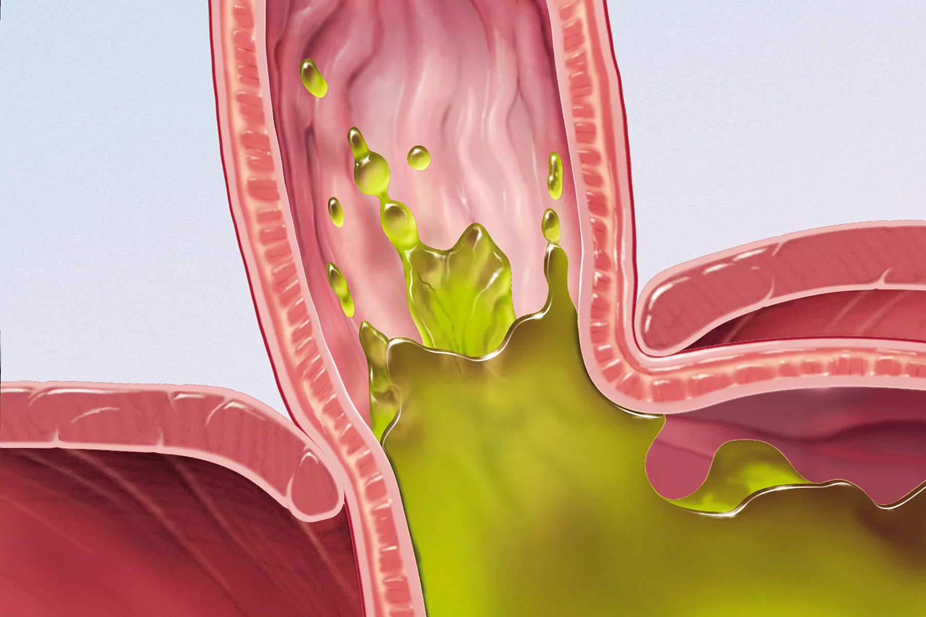 Eosinophilic Esophagitis and Complications