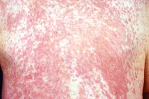 Dermatitis Medicamentosa Dermatitis medicamentosa (more commonly known as “drug eruption”) is a type of skin reaction to certain medications. Its harmless but can cause red patches on the skin and even some blistering.