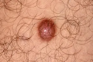 Dermatofibroma. Also called benign fibrous histiocytoma, a dermatofibroma is a non-cancerous fibrous nodule that can occur anywhere on the body, but are more commonly found on the arms, legs and  upper back.  In most cases, they are small and have no symptoms but in rare cases skin cancers may develop within a dermatofibroma.
