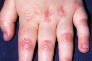 Dermatomyositis. Dermatomyositis is a rare autoimmune disease that is characterized by a distinctive red or purplish rash as well as muscle weakness. It usually shows up where muscles are used to straighten joints like knuckles, elbows, knees, toes or even eyelids. Hard painful lumps can occur, most often in children.