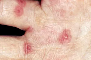Erythema multiforme minor appears as symmetrical rings of red, raised skin that look like targets. Erythema multiforme can appear anywhere on the body. It is most often caused by the herpes simplex virus but has been associated with fungal infections or reactions to medications.