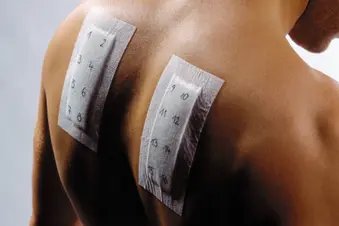 photo of allergy test