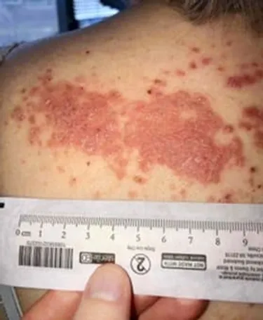 For Williams, psoriasis became severe and affected more of her body, including her back.