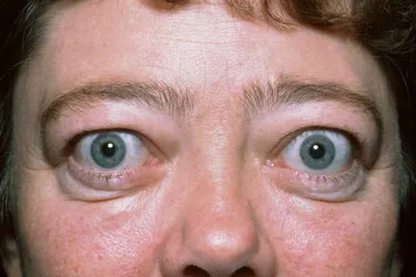 Graves’ disease. Graves’ disease is an autoimmune disease in which your thyroid works harder than it needs to (hyperthyroidism). Some patients develop thyroid eye disease in which their eye muscles and tissues swell, causing the eyes to protrude from their sockets (exophthalmos).
