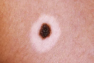 A halo nevus is a mole that is surrounded by a white ring. They are generally benign.