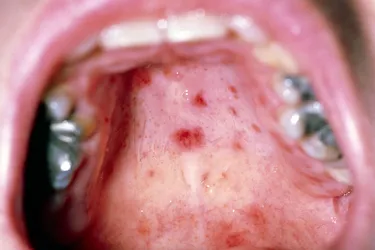 Sores in the mouth from HFMD can be painful. (Photo Credit: Science Photo Library / Science Source)