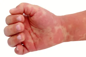 Kawasaki's disease. Kawasaki’s disease usually affects children younger than 5 years old, causing a rash over the body and extremities. Redness and swelling of the palms and soles when the illness starts; peeling of the skin of the hands of feet in the second and third weeks. The main point is to get treatment early to prevent cardiovascular complications.