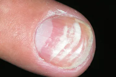 Leukonychia striata. Also called Mees’ lines, these chalky white horizontal streaks on the fingernail are the result of abnormal keratinization in the nail plate. In many cases, there is no obvious cause, but they could be the result of fever, trauma to the nail or malnutrition. The streaks usually grow out or resolve on their own.