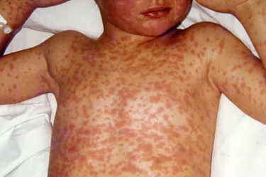 Measles. Measles is an extremely contagious illness caused by a virus that replicates in the nose and throat of those infected. Although typically considered a childhood disease, anyone who is not vaccinated can get it. Symptoms such as a red itchy rash, fever, cough and runny nose usually begin appearing a week after exposure and progress in stages over a period of 2-3 weeks. It’s possible for you to be contagious to others for several days before you know you are sick and remain contagious even after the rash disappears.