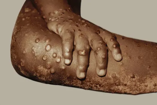monkeypox