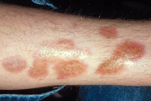 Necrobiosis lipoidica diabeticorum (NLD) is a rash that appears on the skin, most commonly on women. It usually looks like a discolored shiny scar with violet borders. It can itch and become scaly. NLD is linked to blood vessel inflammation related to autoimmune factors as well as type 1 diabetes.