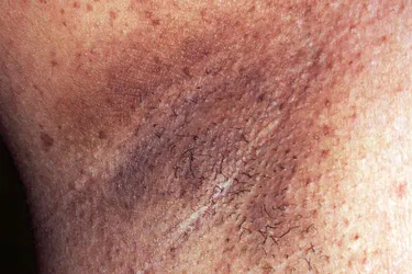 Neurofibromatosis: Crowe's Sign is freckling in the armpit of those with neurofibromatosis type I (von Recklinghausen's disease). Neurofibromatosis is a genetic disorder of the nervous system which affect the growth and development of nerve cell tissue. These freckles occur in up to 30% of people with the disease and their presence is one of six diagnostic criteria for neurofibromatosis. Freckles can also appear in the groin area, along the jaw and in the nape of the neck.