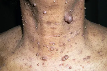 Neurofibromatosis, neurofibromas. Neurofibromatosis is a genetic disorder of the nervous system which causes tumors to form on your nerve tissues. It causes multiple patches of tan or light brown skin and soft, fleshy growths known as neurofibromas to grow on or under your skin.